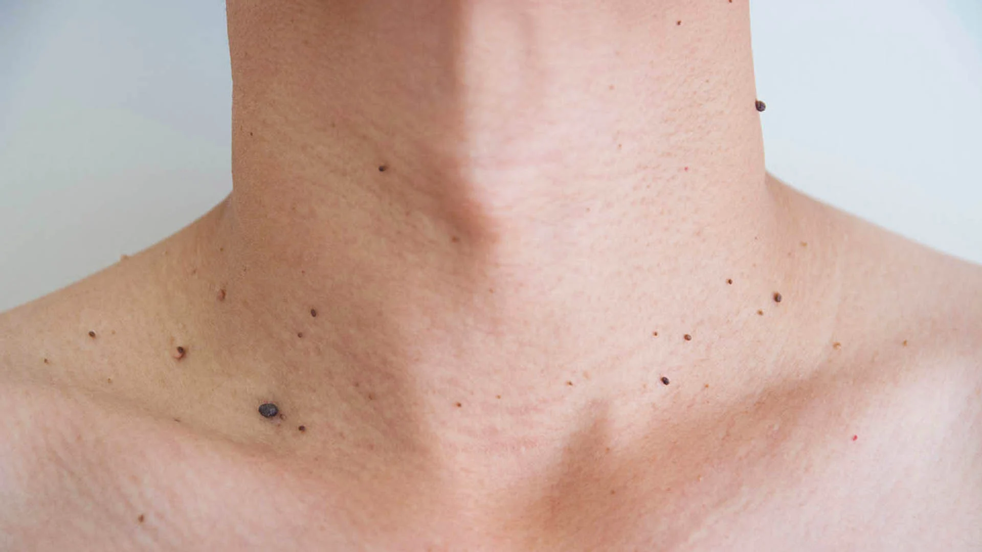 Папіломи: коли звернутися до лікаря перед видаленням